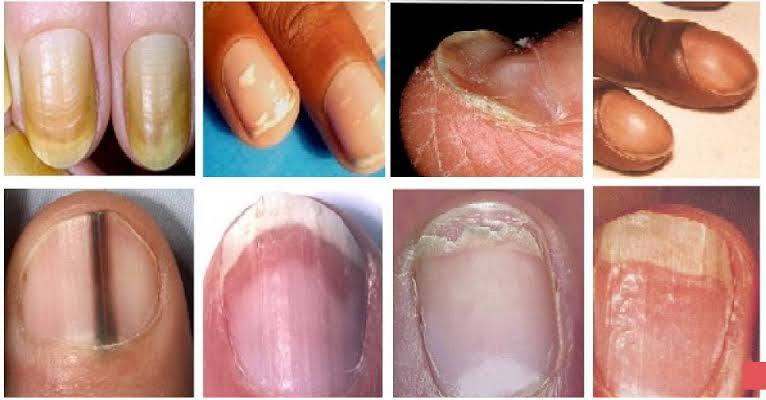 Read more about the article What Your Nails Say About Your Health?