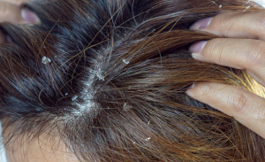 Read more about the article How to get rid of Dandruff?