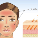 Read more about the article Best Way to Reduce Sun Rash