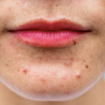 Read more about the article How to get rid of Pustules?