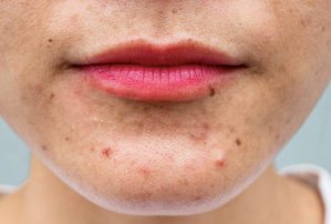 Read more about the article How to get rid of Pustules?