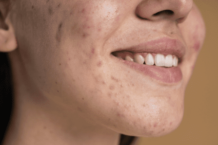 Read more about the article Comedonal Acne: Understanding Symptoms, Causes, Treatment, and Prevention